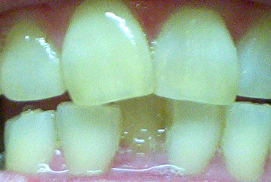 close up photo of crowded front teeth